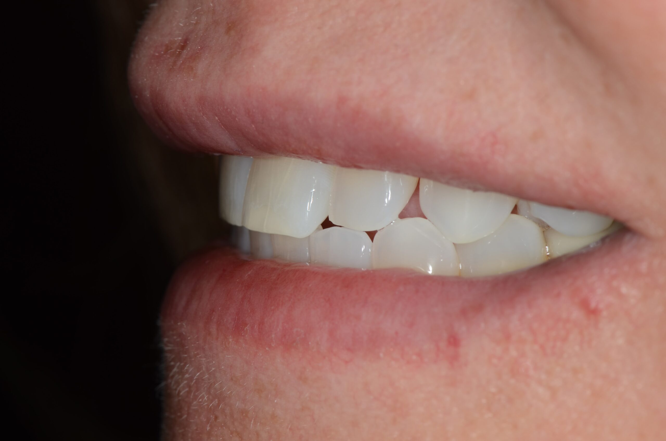Smile Restorations - Mizrachi Dental Lab